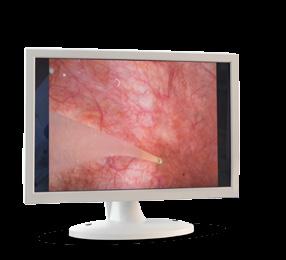 I spetsen på cystoskopet finns en liten kamera som gör att läkaren via en tv-skärm kan se in i urinblåsan.