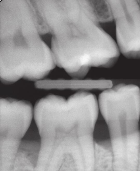 Intraoral röntgen (vanlig tandläkarröntgen) Intraoral röntgen är den överlägset vanligast röntgenundersökningen som utförs i Sverige.