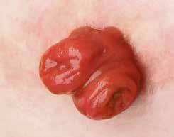 Sammankopplingen behöver 1 En ileostomi kan vara permanent eller tillfällig. ILEOSTOMI Stomin får man vanligtvis därför att tjocktarmen tas bort. Tunntarmen läggs ut på buken som en ileostomi.