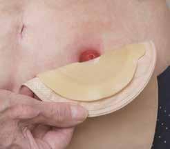 Tvätta rent runt stomin med kompress och ljummet vatten. Klapptorka torrt. Det är lite olika hur ofta man byter sitt bandage. Det är något som din stomiterapeut kommer att prata med dig om.