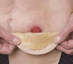 På natten kan du koppla urostomipåsen till en lång urinuppsamlingspåse, så slipper du gå upp och tömma. Töm påsens innehåll i toaletten.