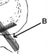 (1p) b) Tidigare ansåg man att meniskerna inte var särskilt viktiga för knäet varför de på ganska vida indikationer togs bort vid skada eller misstanke om skada.
