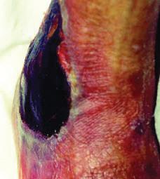 Risk för osteomyelit/osteit Ej kategoriserad okänt djup Genomgripande vävnadsförlust varav basen av såret är täckt av död vävnad (gul, brun, grå, grön eller brun)och /eller sårskorpa (