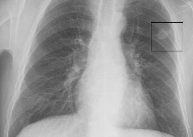 Fortsättning patientfall Kent Smärtdiagnostik Röntgenbilderna granskas igen, det finns en metastas