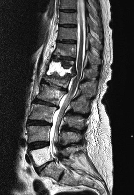 Akuta tillstånd Exempel på allvarliga sjukdomstillstånd som kan presentera sig med ont i ryggen Spondylodiskit Hematogen spridning av bakterier till disk och kotkropp.