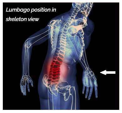 Akuta tillstånd Akut lumbago Duration mindre än 3 månader. Oftast snabbt insättande, ibland efter lyft eller annat mindre trauma.