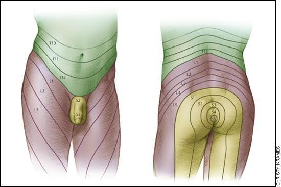Total cauda equina syndrom innefattar utslagen eller kraftigt påverkad funktion i alla Förbipasserande spinalnerver medan partiell cauda kan uppvisa sidoskillnader samt delar av funktion bevarad.