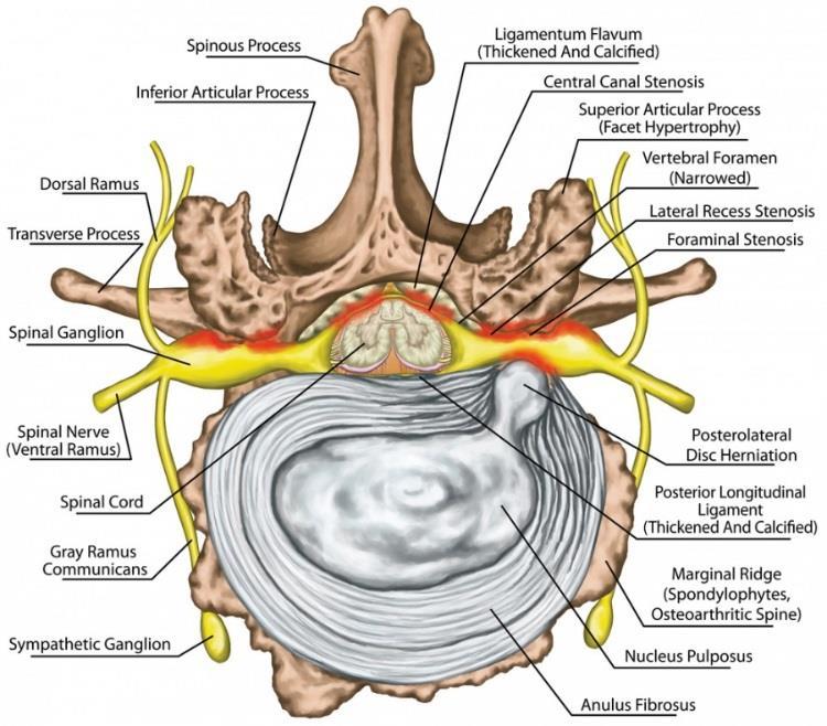 Den typiska symtombilden vid central spinal stenos är pseudoclaudicatio/neurogen claudicatio, medan den laterala stenosen mer har karaktären av ischias/rizopati.