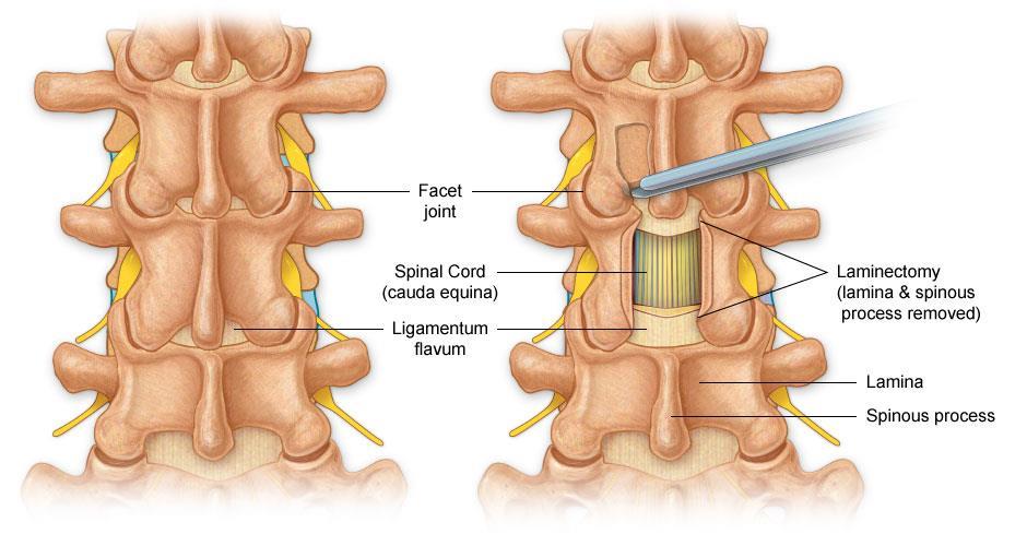 Degenerativa tillstånd tillstånd Central spinal stenos ger ofta sidlika symtom med utstrålande smärta i nedre extremiteter. Förvärras vid extension av ryggen och lindras vid flexion.