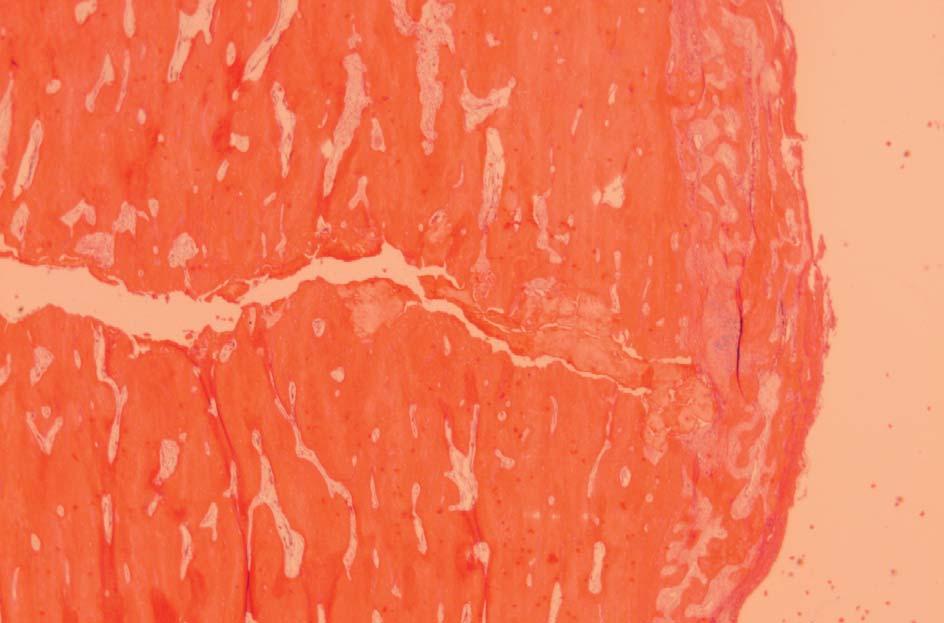 Bild 8. Bisfosfonat.associerad stressfraktur i femurcortex. Sprickans vidgning till vänster är en artefakt. Periostal kallus till höger, som täcker frakturen.