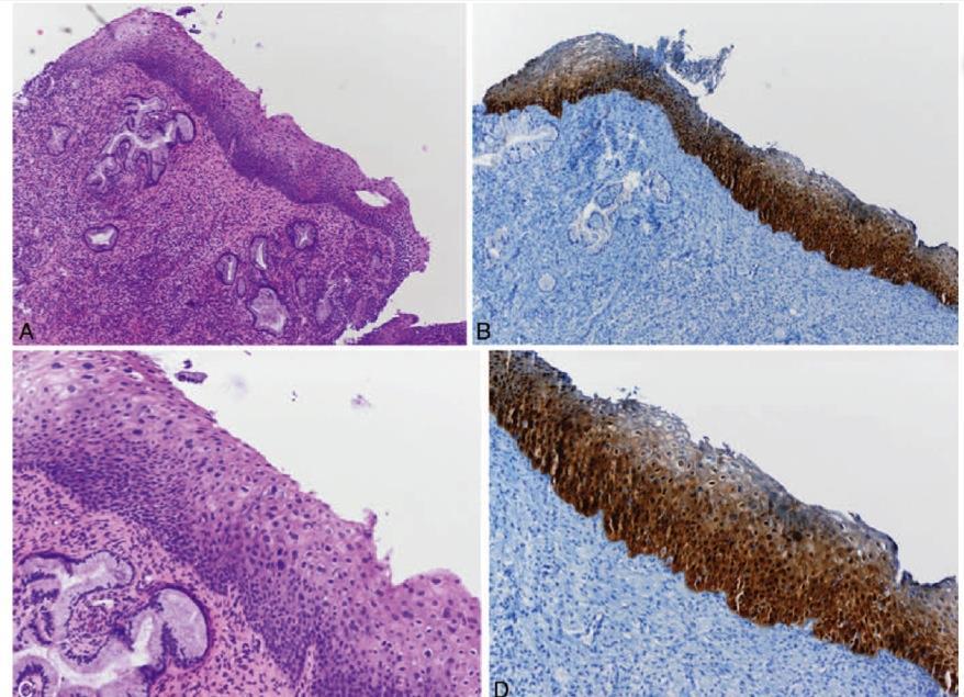 Maligna adenocancerceller innehåller neutralt slem som färgas rӧtt med AB/PAS, medan normala/hyperplastiska endocervikala kӧrtlar innehåller surt och neutralt slem som färgas lilla till blått (13). 6.