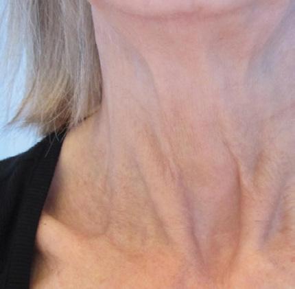 rynkorna på min 65-åriga hals