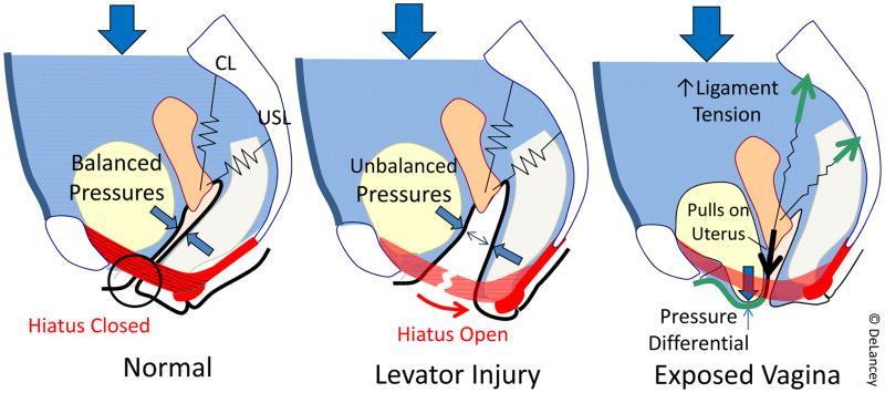 Diagrammatic representation of interactions between levator ani muscle, anterior vaginal wall prolapse, and cardinal/uterosacral ligament suspension.