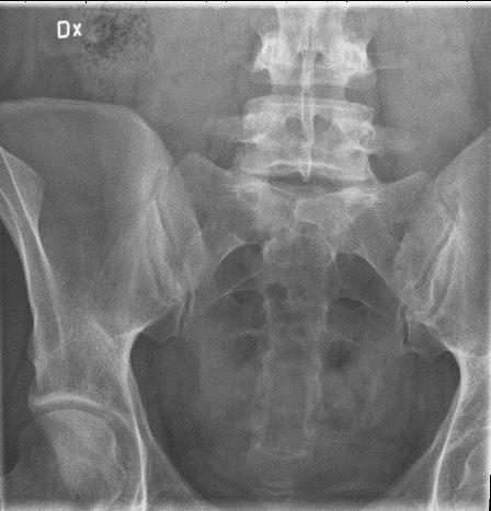 Bild 2 (figur 4) skall avbilda den lumbosacrala övergången, L5-S1 och visar SI-leder och sacrum.