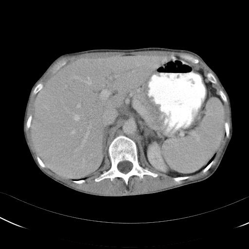 Kan vara relativt tidskrävande Patient stilla / Andhållning CT förstahandsval Nuklearmedicin