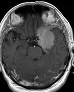 MR förstahandsval Akut (rygg) Trauma (medullapåverkan) Elektivt (skalle, thorax, buk, extremiteter) Hög / Specifik mjukdelskontrast (kontrastmedel) Epilepsi, levermetastaser, medulla Angiografi