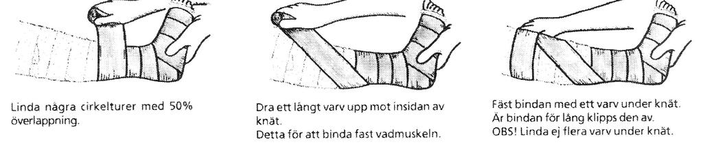 Ur Skaraborgs vårdprogram Behandlingsförslag när det venösa såret är läkt Alternativa behandlingar Kompressionsstrumpor klass 2-3 Strumpor kan används när såret har varit läkt i ~ 4-6 veckor