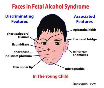 OCH ETT OFÖTT BARN ALLRA MINST FAS = fetalt alkoholsyndrom - ansikts- och huvudanomalier - tillväxthämning - kognitiva dysfunktioner - ca 100 barn/år FASD = spectrum disorder -mindre