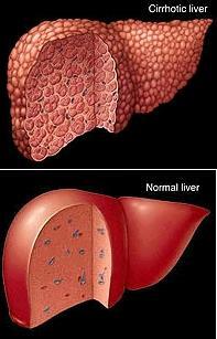 Skrumplever (cirrhos) Den vanligaste anledningen till levertransplantation i västeuropa Bindvävsinlagring i levern Försämrad leverfunktion