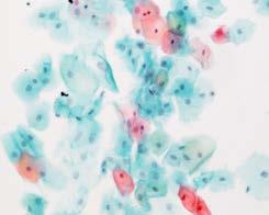 diagnosförslag Vätskebaserad provhantering (LBC) Kombination av cytomorfologi