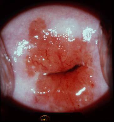 cytologprovet visar onormala celler av olika grad 2.