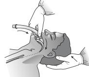 Enheten hålls med tummen i den position som upptas med pekfingret i standardtekniken (Fig.8). Maskens spets pressas mot framtänderna och masken pressas senare mot gommen med tummen.