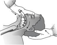Tummens tryck mot den hårda gommen hjälper också till att trycka huvudet bakåt. Böjning av nacken kan också bibehållas med ett huvudstöd.