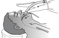 - Flytta inte patienten eller luftvägsmasken under anestesi/operation för att förhindra stimulering av luftvägen.