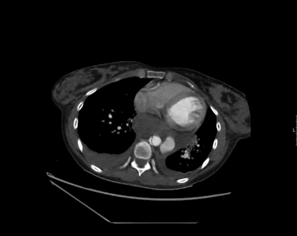 Vikten av lågaktiv sjukdom CT buk:typ B aortadissektion Akut