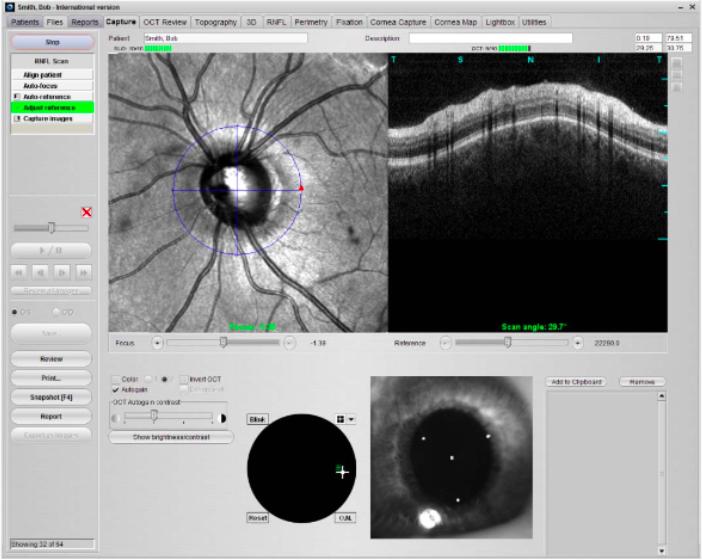 Det retinala nervfiberlagrets tjocklek undersöktes med hjälp av OCT. Patienten placeras med hakan och pannan mot stödet.