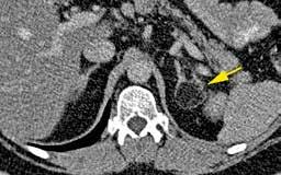 homogen struktur och 4) nativ attenuering <10 HU (Hounsfield-enheter). Figur 4. Datortomografi med intravenös kontrastförstärkning av myelolipom i vänster binjure.