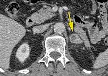 Datortomografi med intravenös kontrastförstärkning av en metastas i vänster binjure från en njurcancer.