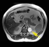 Magnetresonanstomografi med T2-viktning av binjurecysta. Figur 7. Datortomografi med intravenös kontrastförstärkning av vänstersidig binjurecysta med smal förkalkning ventralt. Figur 8.