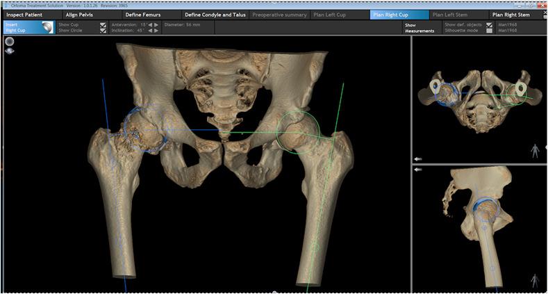 Om Ortoma Ortoma utvecklar operationssystem för planering och positionering av implantat vid höftleds-, knäleds- och ryggkirurgi.