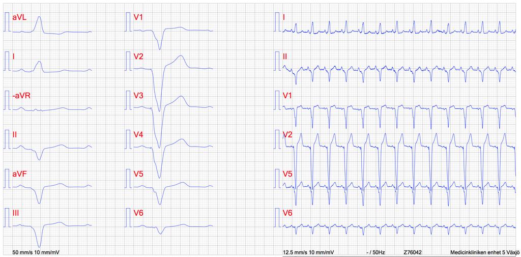 Glöm inte: EKG QRS LBBB NYHA funktionsklass II-IV LVEF (left