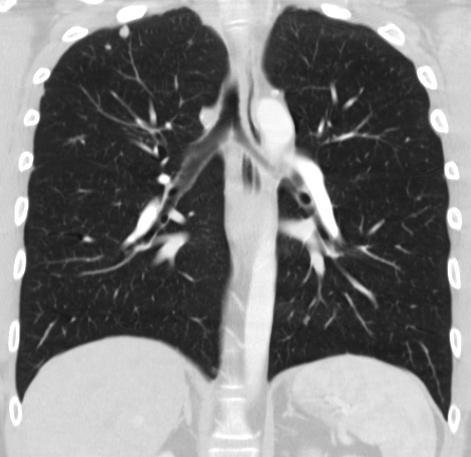 Den vanliga lösningen - datortomografi DT + Reducerat anatomiskt brus + Hög kontrast + Hög
