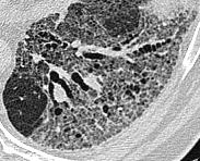 Sekundär lobulus Fibros intralobulära linjer