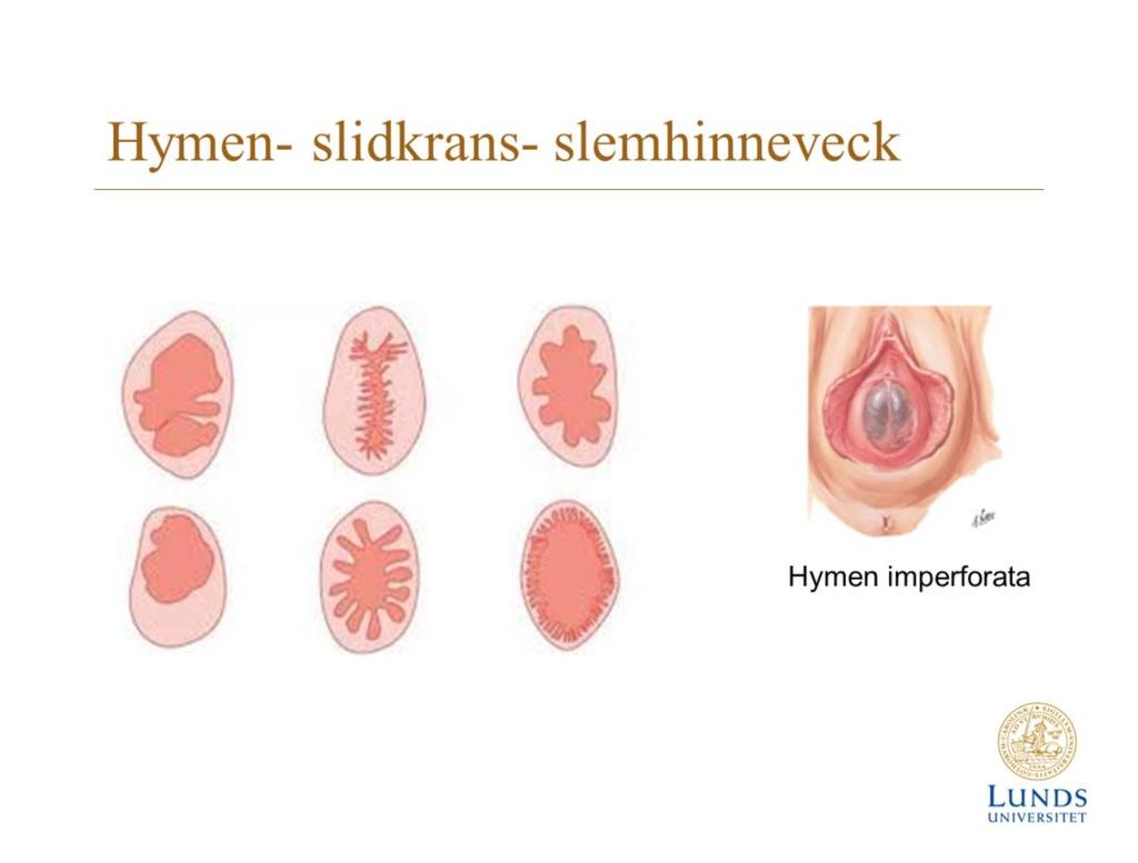 En operforerad mödomshinna är en medfödd sjukdom där en mödomshinna utan öppning hindrar helt slidan. Den orsakas av ett fel i mödomshinnan att perforera under fosterutvecklingen.