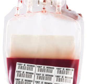 Hemolys Hemolys innebär nedbrytning av röda blodkroppar/erytrocyter. Som en följd av hemolysen frisätts hemoglobin i förvaringslösningen.