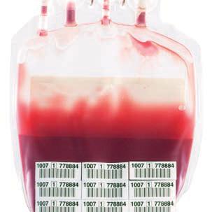 Visuellt utseende - Fritt hemoglobin i erytrocytpreparatets förvaringslösning orsakar färgförändring, som varierar från ljusröd till mörkröd och till och med purpur, beroende på graden av hemolys (ju