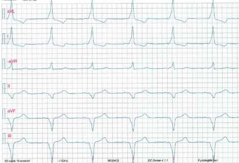 Två vilo-ekg från