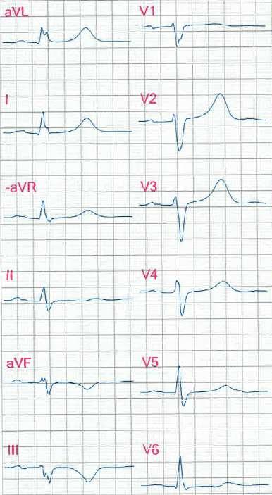Vilo-EKG från patientexempel
