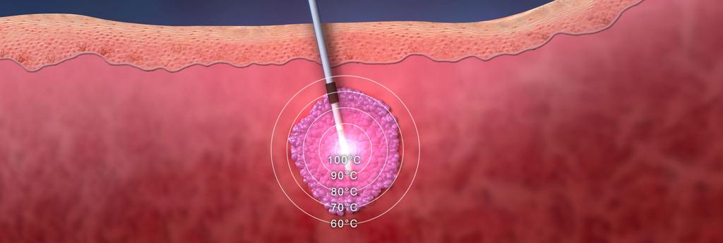 Image guided laser ablation Image-guided laser ablation primarily for treatment of early localized prostate cancer (PCA).