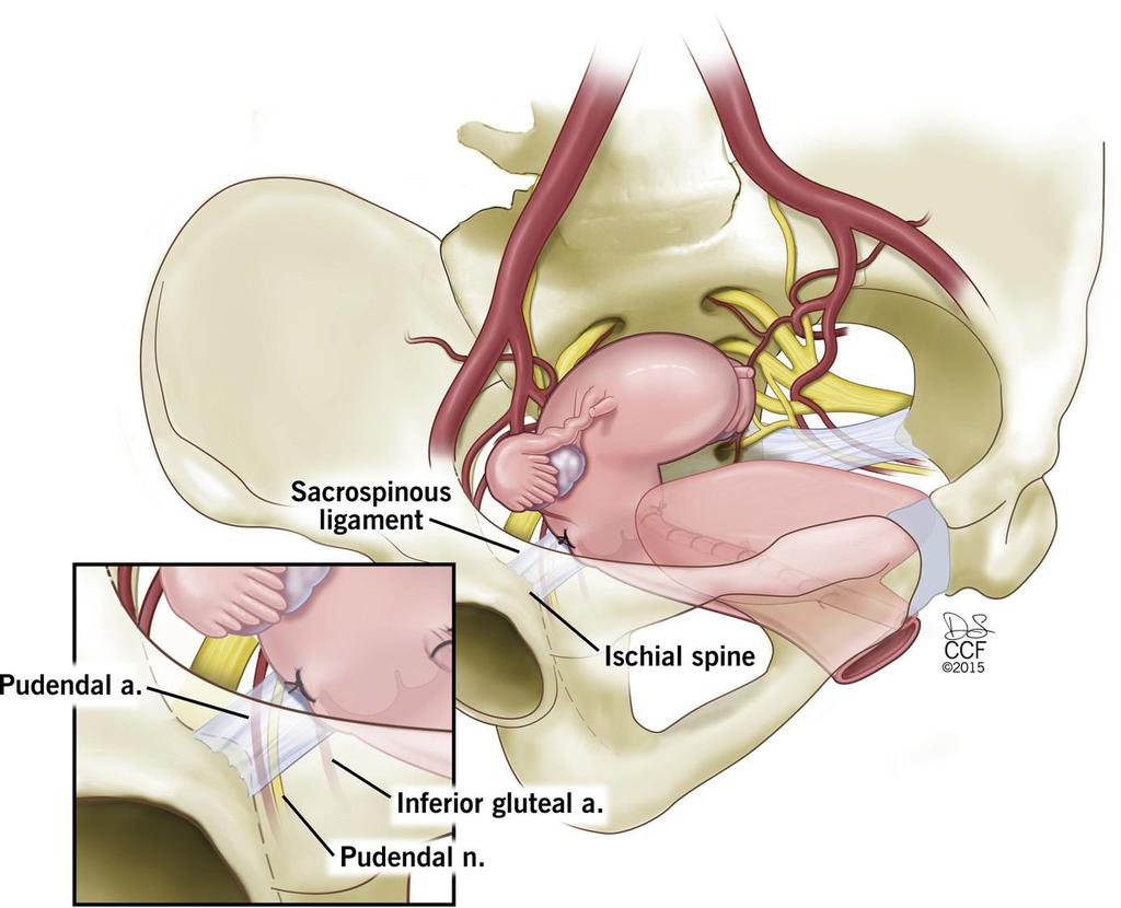Vaginal uteropexi