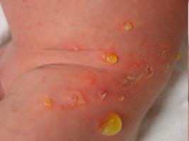 i behandling av impetigo inte