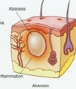 Antibiotikaval vid djurbett VGR: PcV 1g 1x3 i 7-10d Nationellt: PcV 1 g 1x3 i 10 d Amoxicillin-klavulansyra >2d