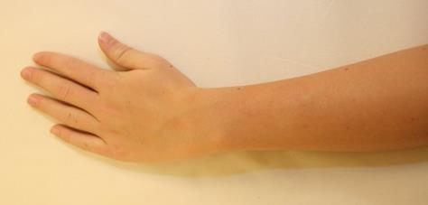 Handledsflexion Ulnardeviation och radialdeviation