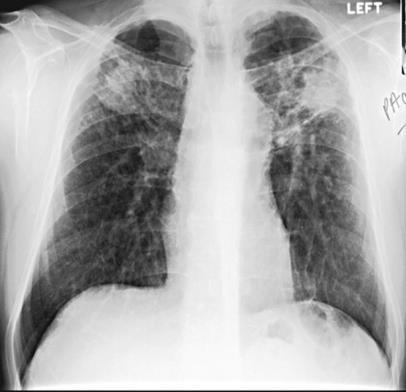 Silikos Diagnos Röntgen Särskild granskning Lungfunktion Själv bästa kontroll Måttlig kvartsnivå lång tid att utveckla Medicinsk kontroll begränsad till