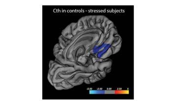 Bruce McEwen, Nature 212 Förtunnad hjärnbark vid utmattningssyndrom Medial prefrontal bark