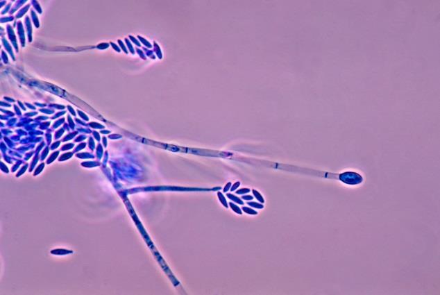 Fusarium Mögelsvamp hyalohyphomycosis. > 100 arter Jord, luft, vatten, växter. Global fr a inhalation, även hudskador Fusarium solani, F oxysporon, F verticillioides, F profileratum.